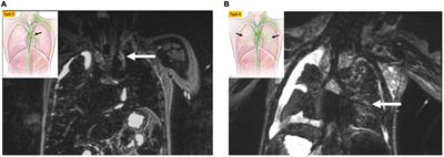 Lymphatic Disorders in Patients With Single Ventricle Heart Disease